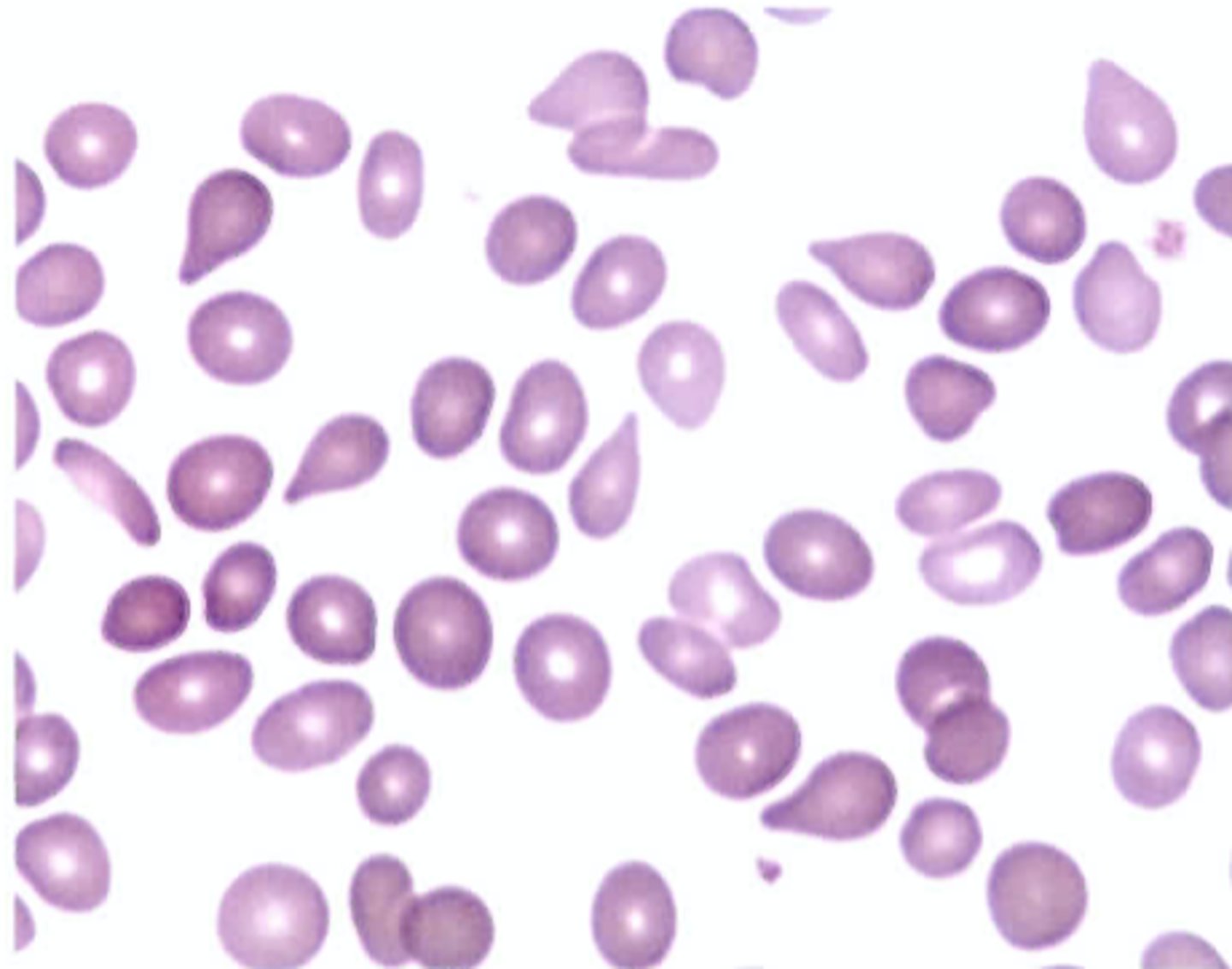 <p>D. Dacryocytes; myelofibrosis</p>