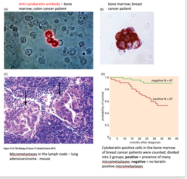 <ul><li><p class="Paragraph WhiteSpaceCollapse SCXP266156057 BCX0" style="text-align: left"><span>Once cancer cells enter the parenchyma –may form <strong>micrometastases </strong>= small clumps of disseminated cancer cells, some are able to expand to clinically detectable masses =<strong> colonization (most complex and challenging step)</strong>​</span></p></li><li><p class="Paragraph WhiteSpaceCollapse SCXP266156057 BCX0" style="text-align: left"><span>New tissue environment does not provide the cancer cells with the collection of familiar growth and survival factors that they encountered at the primary site.​</span></p></li><li><p class="Paragraph WhiteSpaceCollapse SCXP266156057 BCX0" style="text-align: left"><span>Able to detect micrometastases with specific antibodies ​</span></p></li></ul><p class="Paragraph WhiteSpaceCollapse SCXP266156057 BCX0" style="text-align: left"></p><ul><li><p class="Paragraph WhiteSpaceCollapse SCXP143761481 BCX0" style="text-align: left"><span>The probability of an individual cancer cell completing all of the steps of the invasion-metastasis cascade is very low.​</span></p></li><li><p class="Paragraph WhiteSpaceCollapse SCXP143761481 BCX0" style="text-align: left"><span><strong>Colonization = the rate-limiting step</strong>​</span></p></li><li><p class="Paragraph WhiteSpaceCollapse SCXP143761481 BCX0" style="text-align: left"><span>Micrometastases may persist for extended amounts of time in a dormant state​</span></p></li></ul><p class="Paragraph WhiteSpaceCollapse SCXP266156057 BCX0" style="text-align: left"><span>​</span></p><p class="Paragraph WhiteSpaceCollapse SCXP266156057 BCX0" style="text-align: left"></p><p></p>