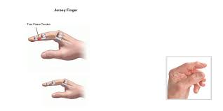 <ul><li><p><span>Etiology</span></p><ul><li><p><span>Rupture of flexor digitorum profundus tendon from insertion of distal phalanx</span></p></li><li><p><span>Often occurs with ring finger when athlete tries to grab a jersey</span></p></li></ul></li><li><p><span>Signs and Symptoms</span></p><ul><li><p><span>PIP can not be flexed, finger remains extended</span></p></li><li><p><span>Pain and point tenderness over distal phalanx</span></p></li></ul></li><li><p><span>Management</span></p><ul><li><p><span>Must be surgically repaired</span></p></li><li><p><span>Rehab requires 12 weeks and tehre is often poor gliding of tendon with possible of re-repture</span></p></li></ul></li></ul><p></p>