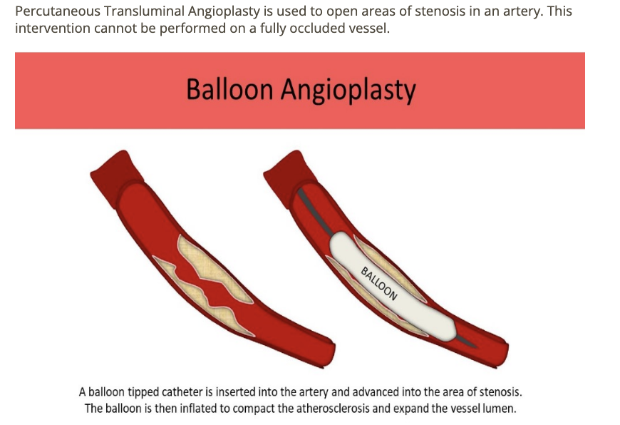 <p>c) pt w/80% stenosis in prox SFA </p>