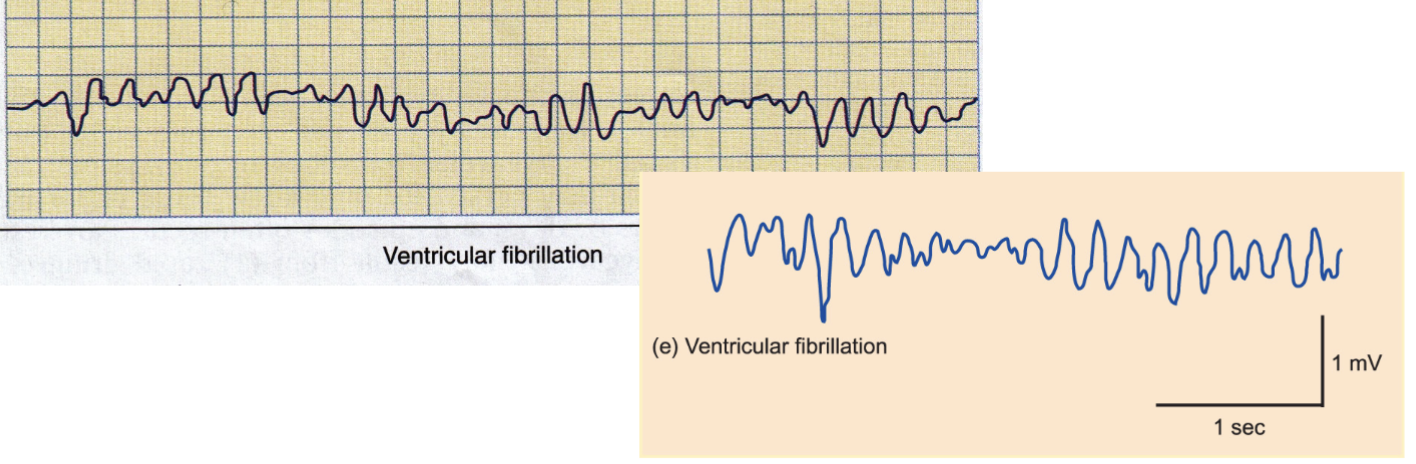 Life-threatening arrhythmia in which the lower chambers of the heart (ventricles) quiver & cannot pump blood effectively.

