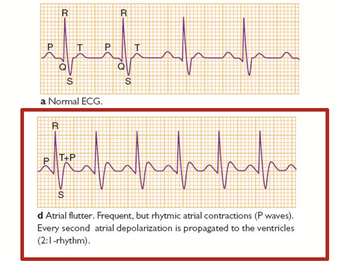 <p>Happens when a short circuit in the heart causes the upper chambers to pump very rapidly. Frequent, but rhythmic atrial contractions (P waves). Every second atrial depolarization is propagated to the ventricles.</p>