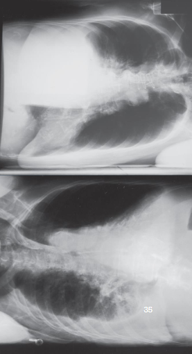 <ul><li><p>structures shown:</p><ul><li><p>anatomy of thorax </p></li><li><p>air or fluid levels</p></li></ul></li><li><p>evaluation criteria:</p><ul><li><p>no motion or rotation</p></li><li><p>affected side in its entirety</p><ul><li><p>upper lung for free air</p></li><li><p>lower lung for fluid</p></li></ul></li><li><p>arms out of region of interest</p></li></ul></li></ul><p></p>