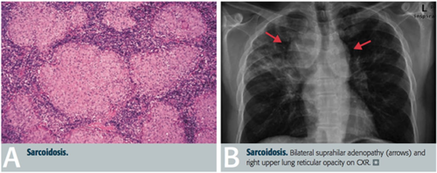 <p>Sarcoidosis (non-caseating granulomas)</p>
