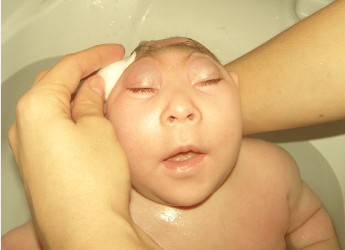 <p>anencephaly</p>