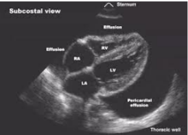 <p>What does pericardial effusion look like on US?</p>