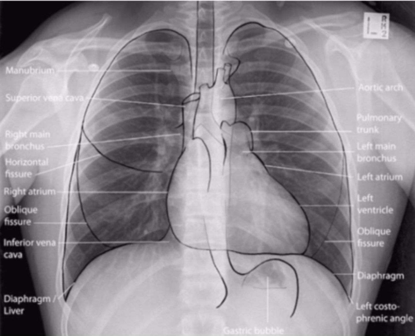 <p>is the study of body structures that can be <u><mark data-color="#dceef1" style="background-color: rgb(220, 238, 241); color: inherit;">visualized with </mark></u><strong><u><mark data-color="#dceef1" style="background-color: rgb(220, 238, 241); color: inherit;">x-rays</mark></u></strong>.</p>