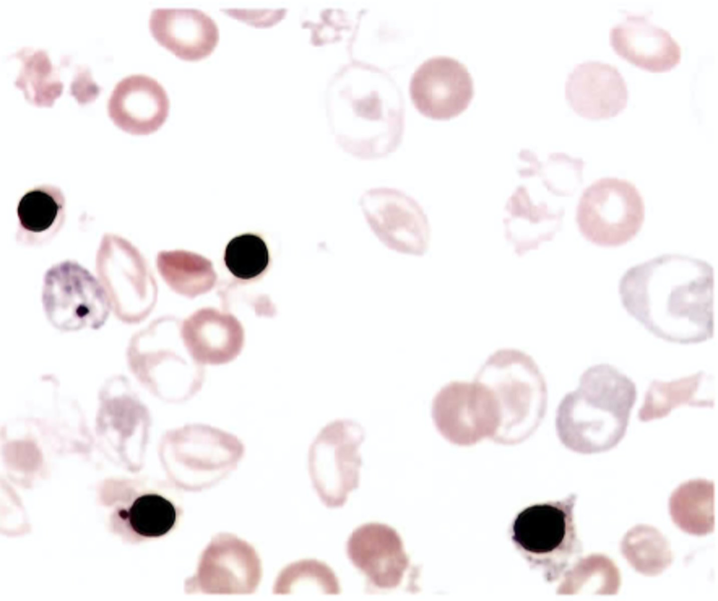 <p>B. Cooley beta-thalassemia major</p>
