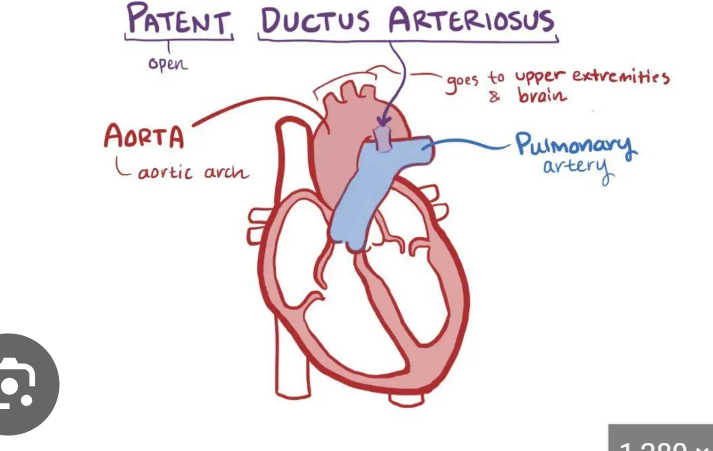 <p>aka DA, a temporary blood vessel that connects the aorta to the pulmonary artery, during fetal development the DA allows blood to bypass the non-functional lungs (fetus recieves oxygen from placenta)</p>
