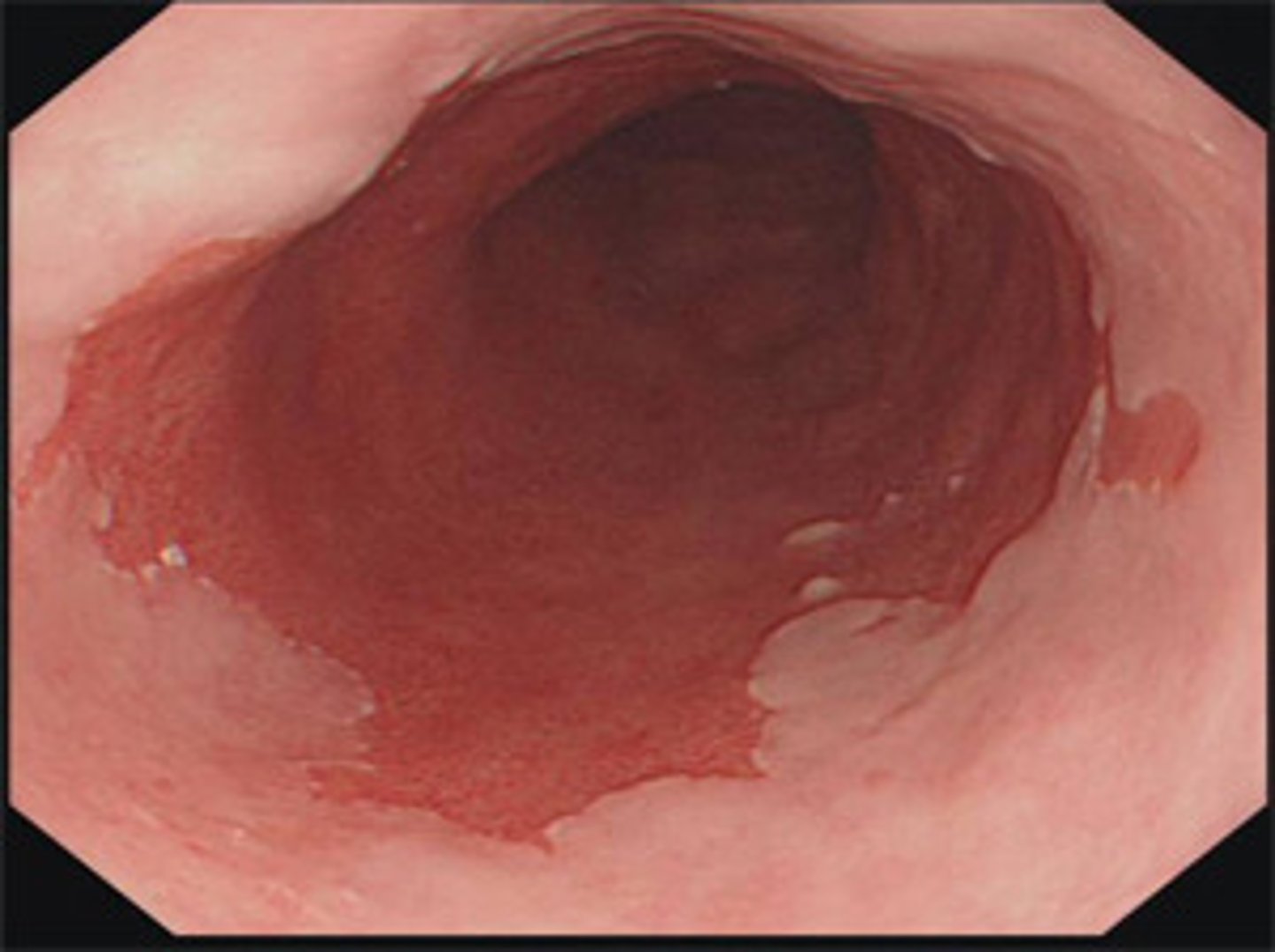 <p>1.) Endoscopy</p><p>2.) Biopsy is needed for diagnosis</p><p>3.) Long-term PPIs once or twice daily to control reflux symptoms</p>