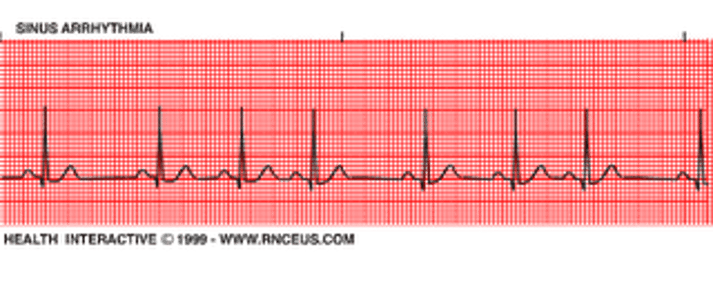 <p>Sinus dysrhythmia</p>