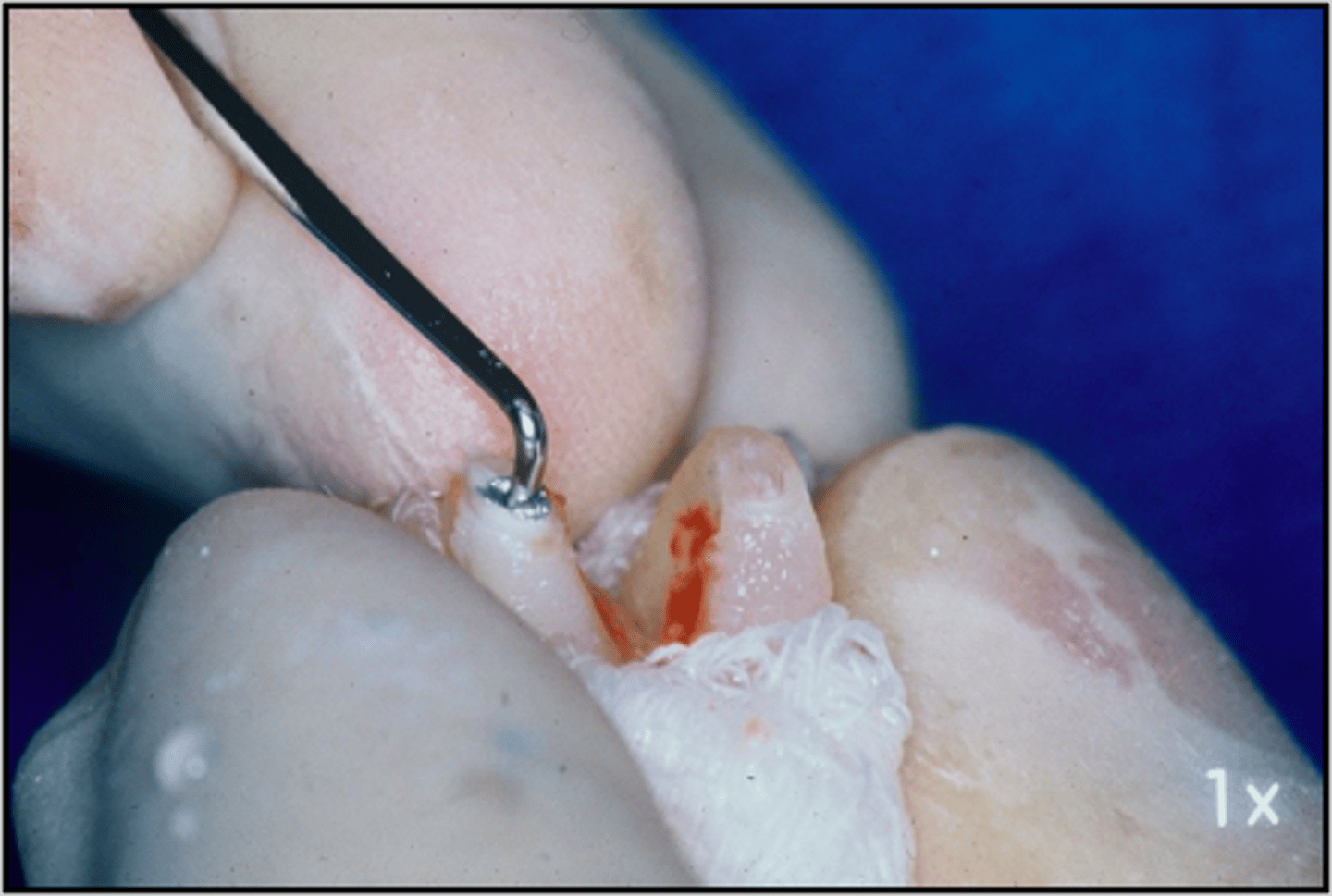 <p>ID the surgical procedure:</p><p>- Performed when surgery is indicated, but access is impossible: </p><ol><li><p>Atraumatic extraction</p></li><li><p>Apicoectomy with retroprep and retrofil</p></li><li><p>Irrigate socket with saline</p></li><li><p>Replantation and splint</p></li></ol><p></p>