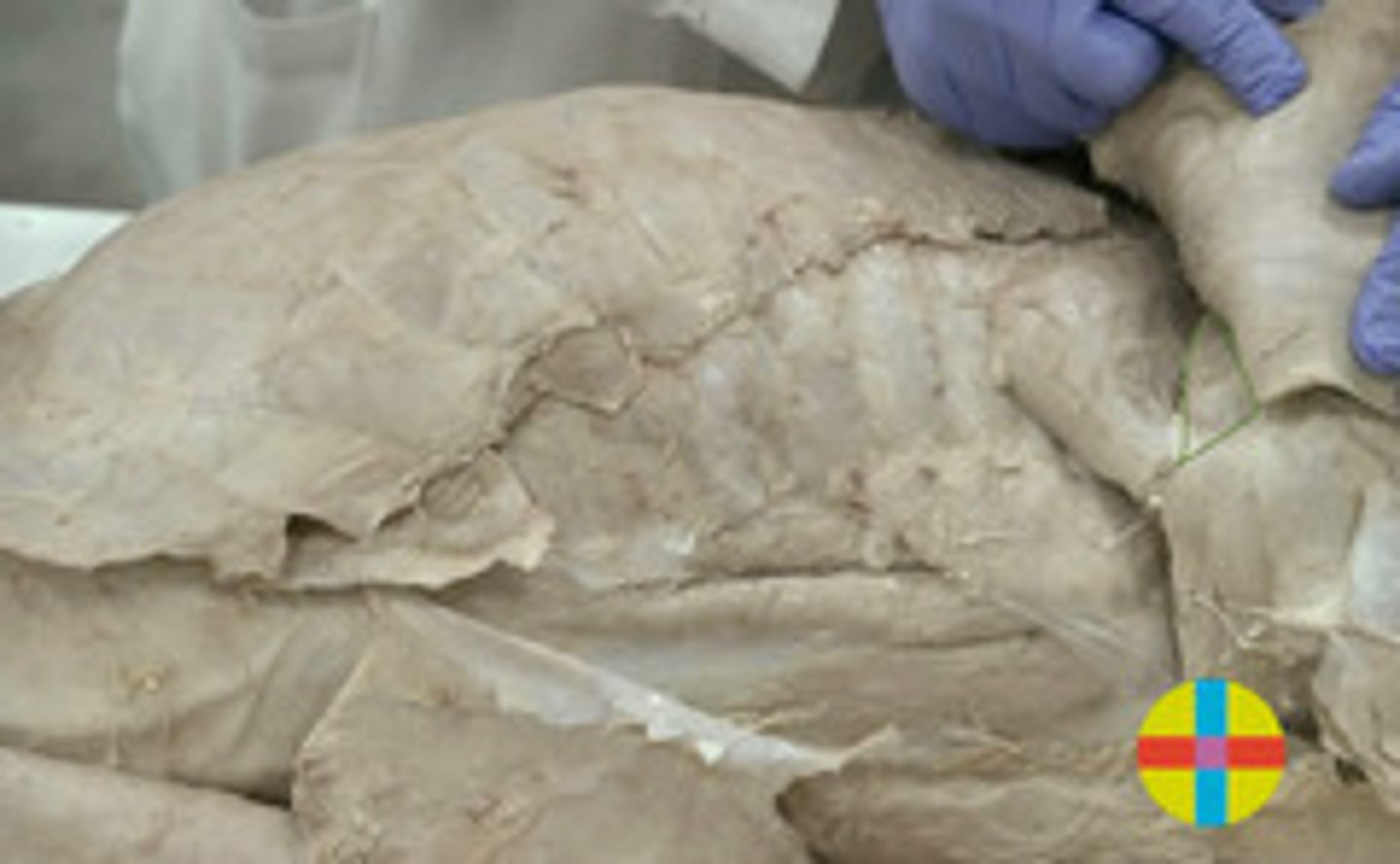 <p>Origen: borde cd escápula</p><p>Inserción: tuberosidad del redondo mayor del</p><p>húmero (junto m. dorsal ancho)</p><p>Función: flexor hombro</p><p>Inervación: axilar y toracodorsal</p>