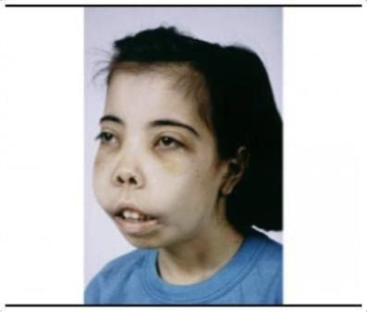 <p>What does this refer to</p><ul><li><p>Mild-moderate anemia</p></li><li><p>Hepatosplenomegaly</p></li><li><p>Jaundice</p></li><li><p>Heart defects</p></li><li><p>Increased bone marrow hematopoiesis</p><ul><li><p>Frontal bossing</p></li><li><p>Maxilla overgrowth</p></li></ul></li><li><p>Abnormalities of the urinary system or genitalia</p></li></ul><p></p>