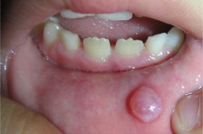 <p>Where might you find a mucocele? What are the clinical symptoms?</p>