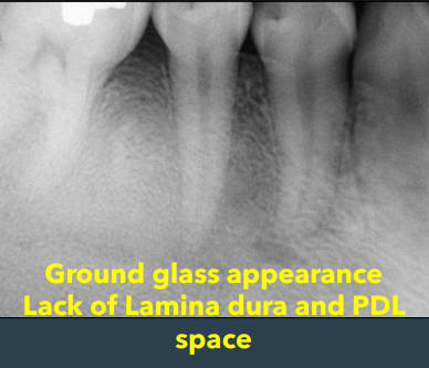 <ul><li><p>ground glass opacification </p></li><li><p>not well demarcated, blending </p></li><li><p>narrow PDL </p></li><li><p>ill-defined lamina dura </p></li><li><p>Obliteration of the maxillary sinus </p></li></ul><p></p>