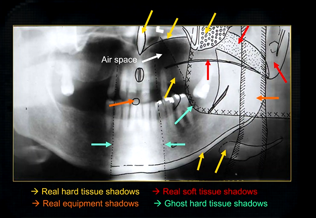 <ul><li><p>mandible from the opposite side</p></li><li><p>cervical spine </p></li><li><p>shadows of the air space - between the tongue and the roof of the mouth </p></li></ul><p></p>