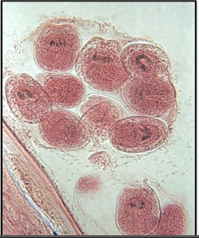 <p><strong>Name the parasitic stage.</strong></p><ul><li><p>Hydatid cyst</p></li></ul><p><strong>Mention special characteristics of the stage.</strong></p><ul><li><p>Wall has <strong>two layers</strong>: outer laminated non-cellular layer and inner cellular germinal layer</p></li><li><p>Contents include <strong>individual scolices, brood capsules, daughter cysts, hydatid fluid, and hydatid sand</strong></p></li></ul><p><strong>Name the intradermal test used for diagnosis of this disease.</strong></p><ul><li><p>Casoni test</p></li></ul><p><strong>What is the definitive diagnostic method?</strong></p><ul><li><p><strong>Surgical removal of the cyst</strong> and confirmation of its structure and contents <strong>histologically</strong></p></li></ul><p></p>