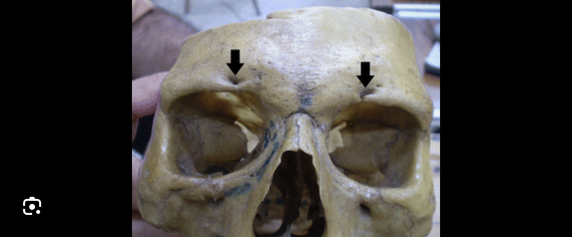 <p>What bone marking is this?</p>