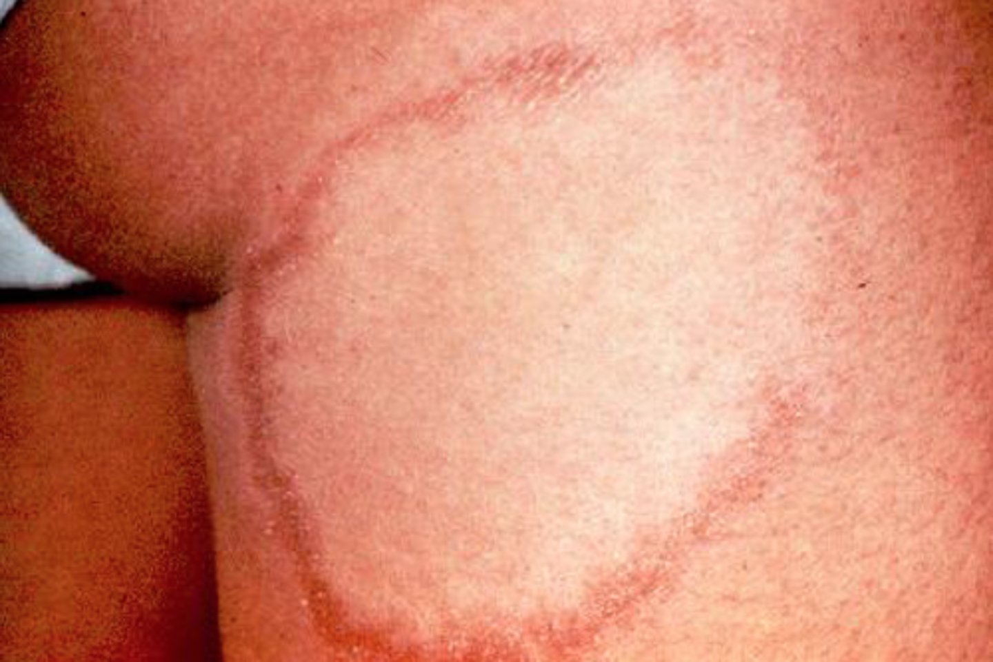 <p>Paucibacillary leprosy (tuberculoid)</p>