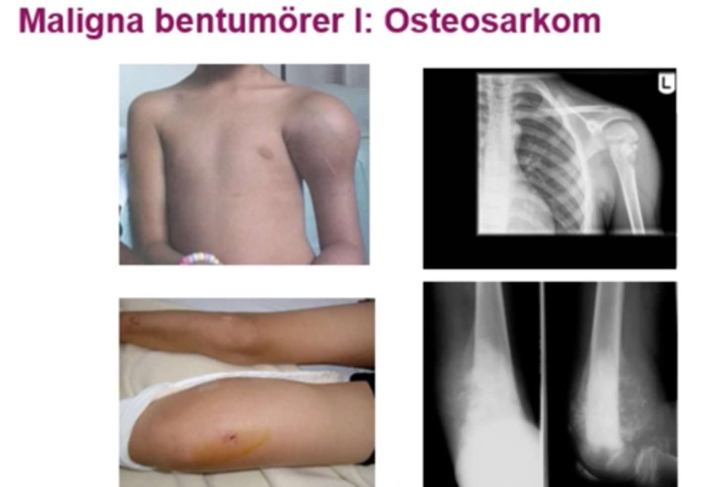 <p>En sällsynt form av bencancer där osteoblaster omvandlas till cancerceller</p>