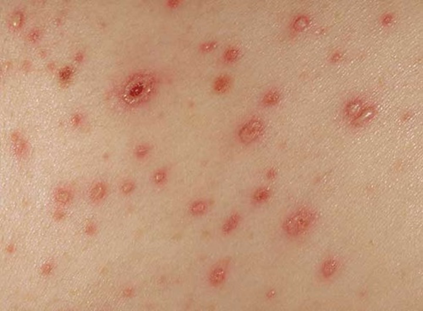 <p>Varicella (Chickenpox) - vesicles in different stages of healing</p>