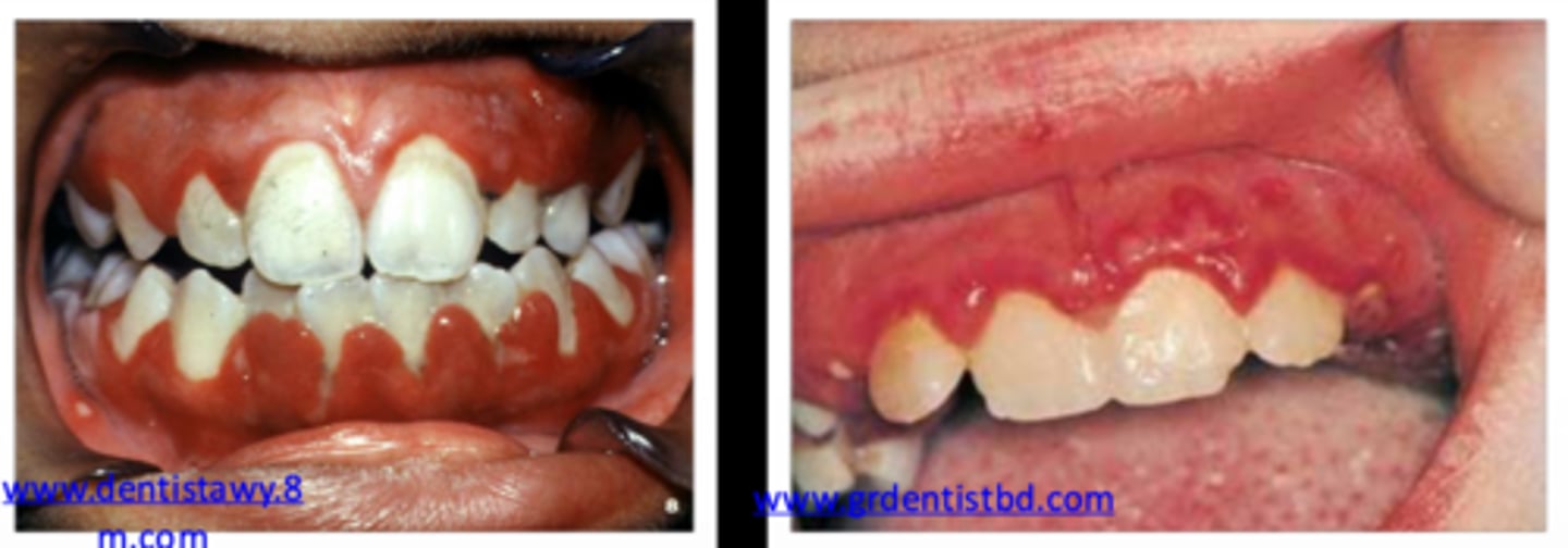 <p>false; primary herpes (primary herpetic gingivostomatitis) must present with ulcerations on the keratinized AND non-keratinized tissues</p>
