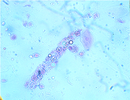 <p>-Hyaline casts which contain lipid droplets and can be overserved in pts with lipuria</p><p>-Associated with Nephrotic syndromes</p>