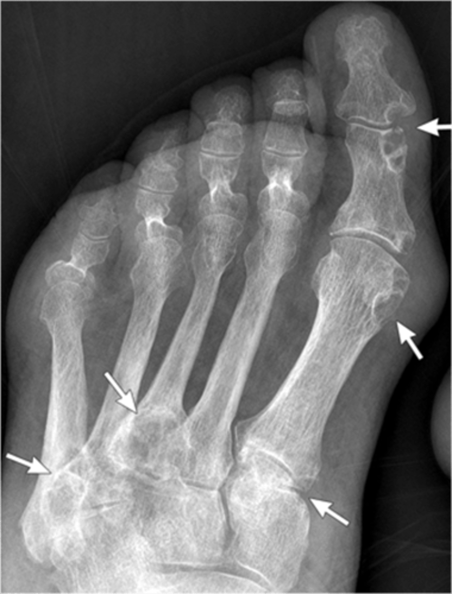 <p>- Hyperuricemia with secondary sodium monourate crystal deposition:</p><p>• Cartilage</p><p>• Synovium</p><p>• Periarticular</p><p>• Subcutaneous</p>