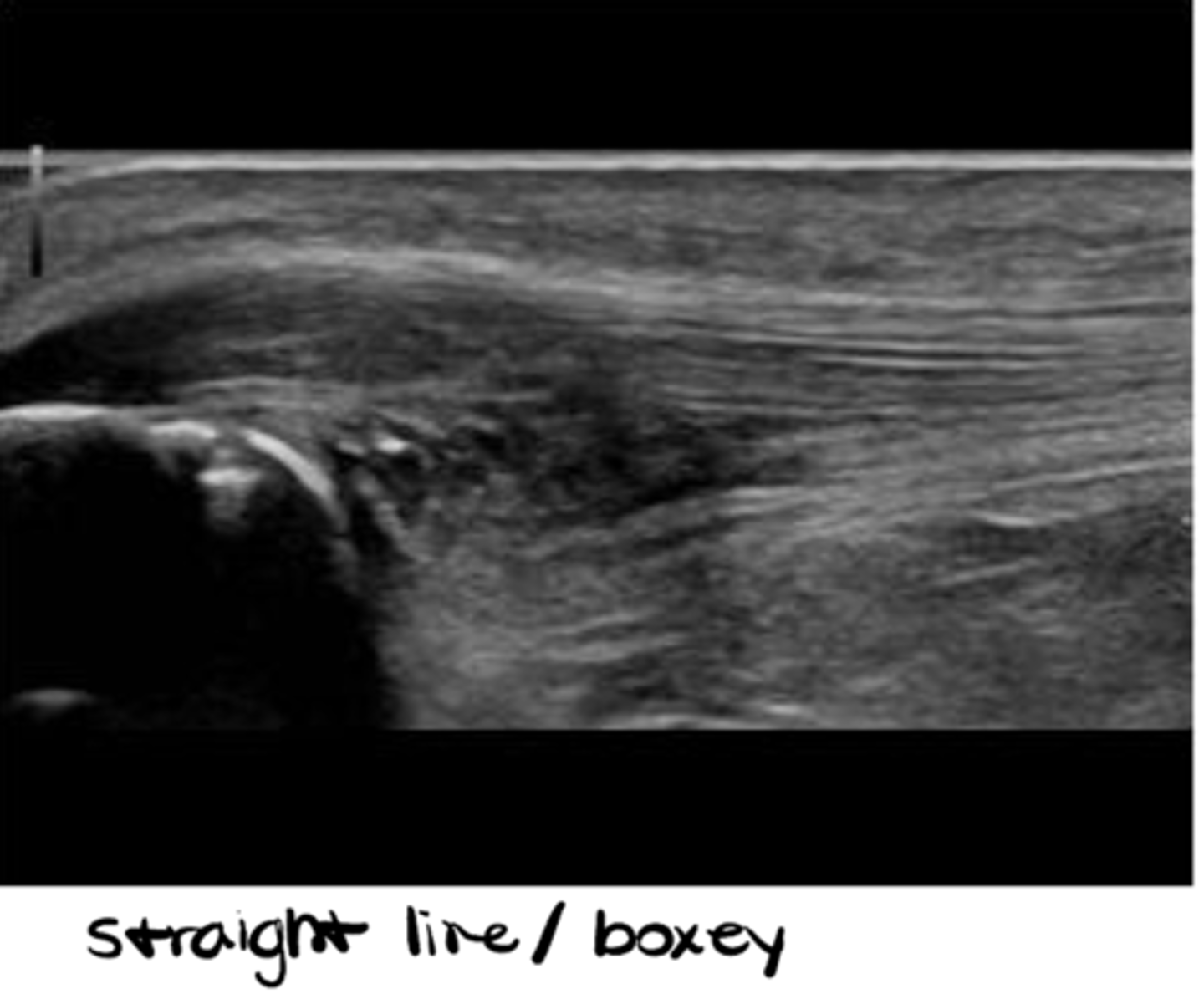 <p>Tendons, ligaments, muscles, joints (first inch or two)</p>