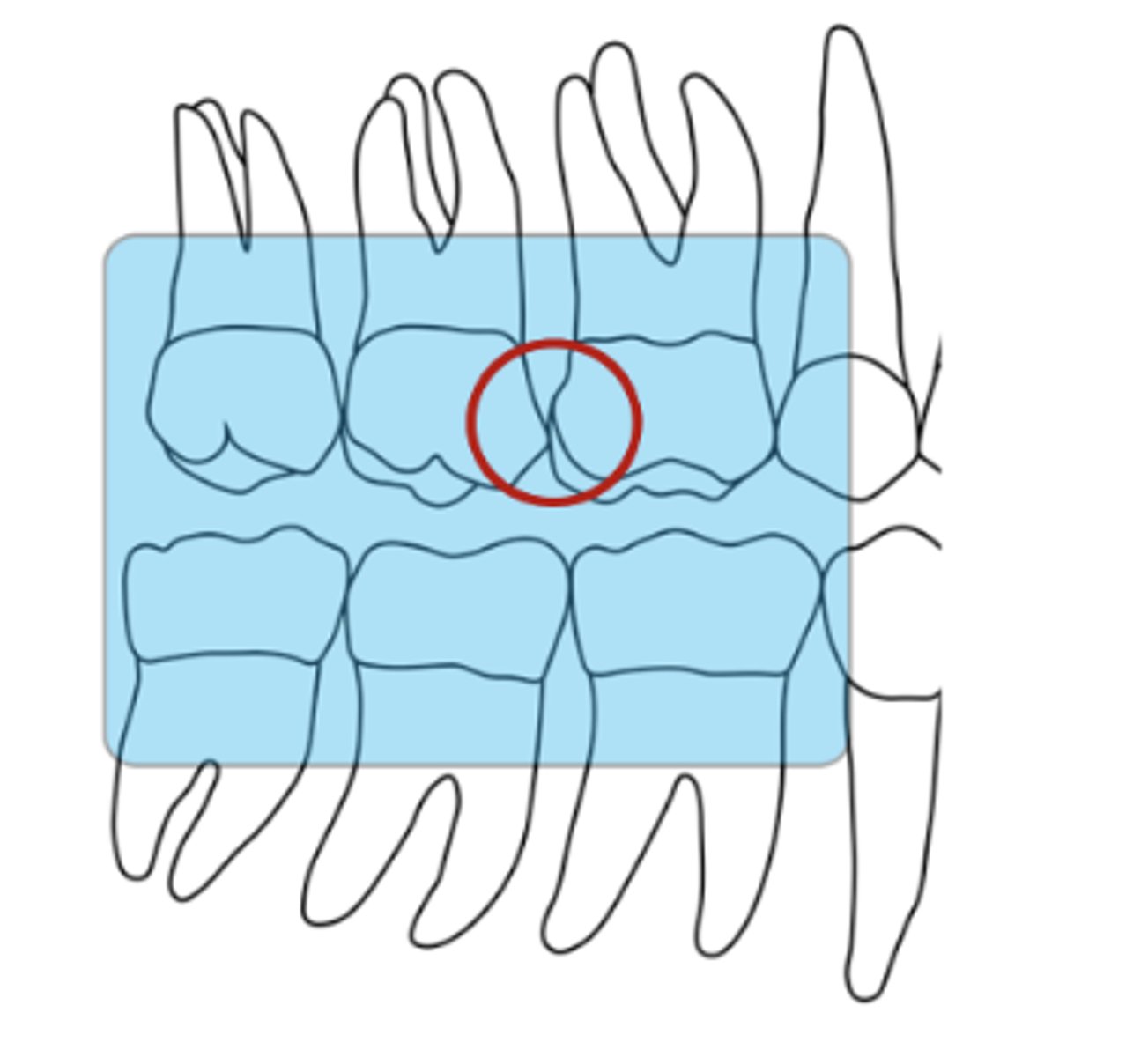 <p>horizontal angle is</p><p>determined by paralleling the central ray with the interproximal contact between the first and second maxillary molars</p><p>(In the case of erupted third molars, supplemental bitewings may need to be done to record all interproximal contacts)</p>