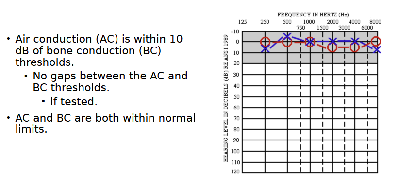 <p>“Normal hearing sensitivity bilaterally”</p>