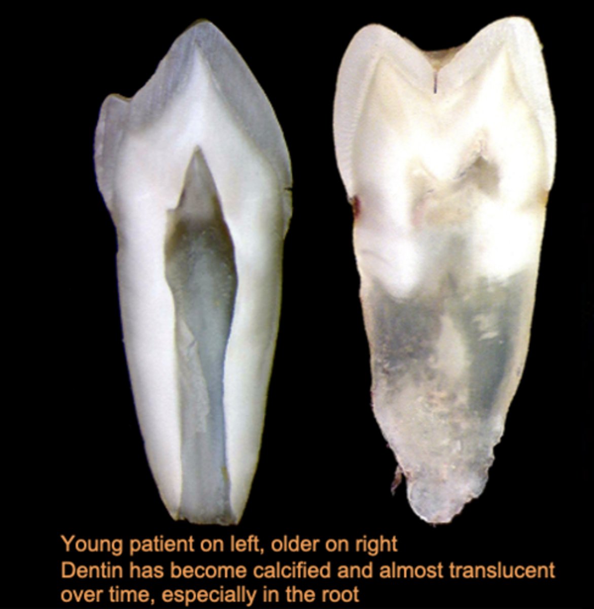 <p>Dentin that has become translucent due to calcification of the dentinal tubules. As a result of injury or normal aging. Also called transparent dentin.</p>