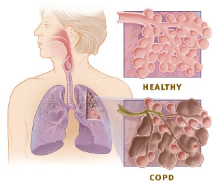 <p>a group of chronic lung conditions that cause airflow obstruction, making it difficult to breathe; primary causes are cigarette smoking, air pollution and genetics </p>