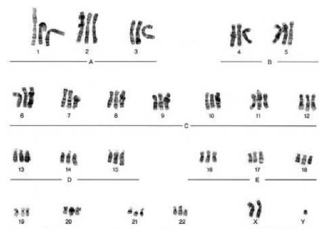 More than 46 chromosomes, miscarriage, male, multiple trisomies (3 chromosomes in a pair), This karyotype resulted from nondisjunction of an entire cell, The haploid number of this person is over 34.