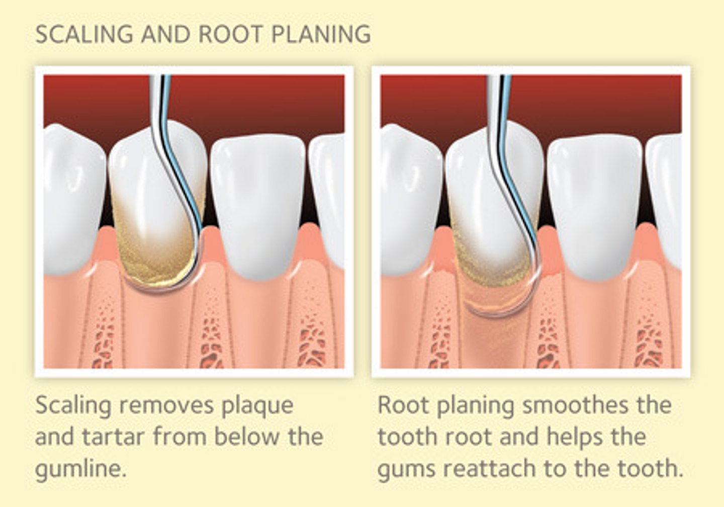 <p>Removal of the cementum on the exposed root surface</p>