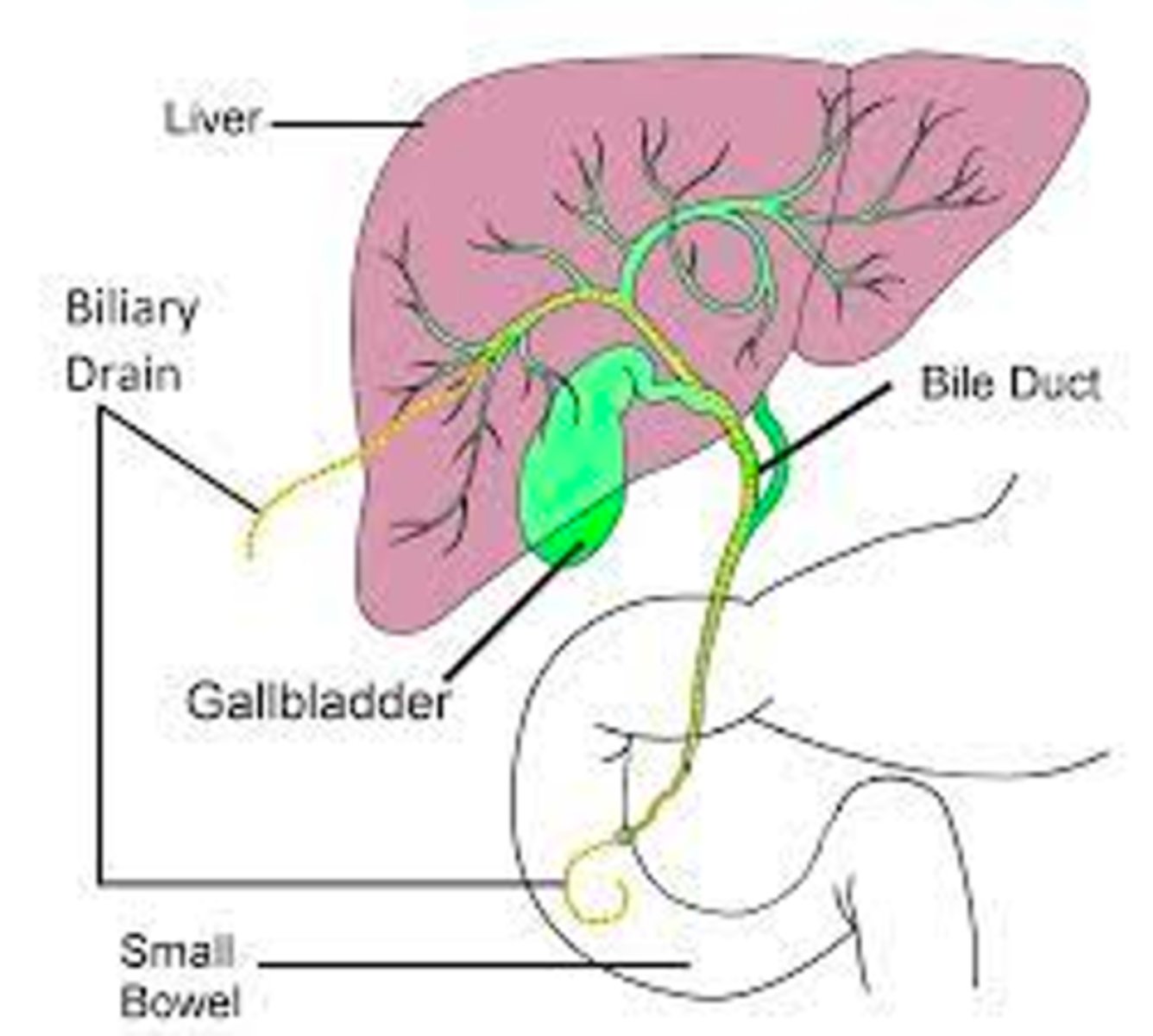 <p>a minimally invasive, image-guided procedure (using X-ray or ultrasound) that places a thin tube (catheter) through the skin and into the liver to relieve bile duct blockages from liver to duodenum</p><p>Internal &amp; External Drain</p><p>Placed by Interventional Radiology</p>
