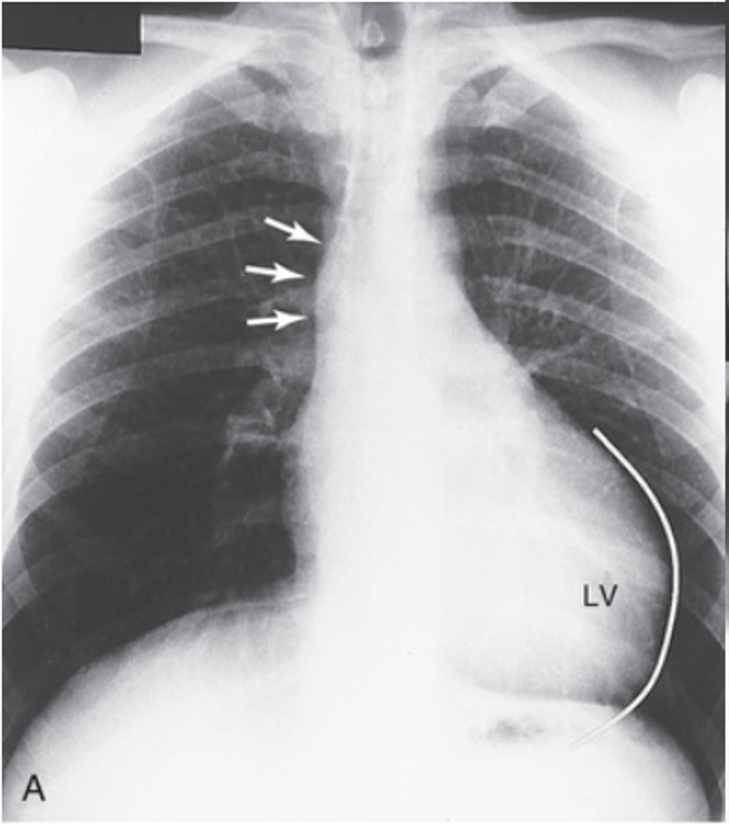 <p>- rounding of the cardiac apex</p><p>- Apex is pointing down and projects below left hemidaphigram</p>