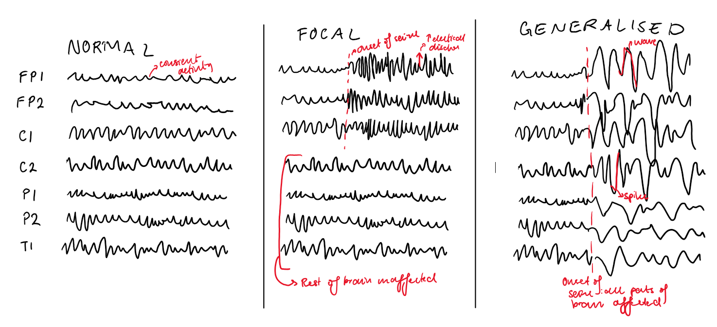 <p>Epilepsy = tendency to have convulsions/ transient abnormal events resulting from paroxysmal discharge of cerebral neurons</p><p><u>Diagnosis</u>:</p><ul><li><p>2 or more unprovoked seizures more than 24 hrs apart</p></li><li><p>Risk of another seizure after 1 unprovoked seizure the same as after 2 unprovoked seizure</p></li><li><p>In reflex epilepsy, at least 2 seizures in response to event (e.g. strobe lights)</p></li><li><p>Signs: focal or generalised involvement of the brain, impaired awareness and/ or motor involvement (depends on type of seizure)</p><ul><li><p>Tonic clonic: generalised, impaired awareness with tense muscles and clonus</p></li><li><p>Absence seizures: focal with brief lack of response </p></li></ul></li><li><p>EEG shows sudden sustained and rhythmic firing </p></li></ul><p><u>Treatment</u>:</p><ul><li><p>Antiepileptic drugs (e.g. phenytoin, valproate, levetriacetam)</p></li><li><p>Vagal nerve stimulation (extreme cases)</p></li></ul><p></p><p><u>Status epilepticus:</u> medical emergency when seizure lasts >5 minutes or without rcovery period in between 2 seizures</p><ul><li><p>Treatment: benzodiazepines, AED’s, intubation and ICU</p></li></ul><p></p>