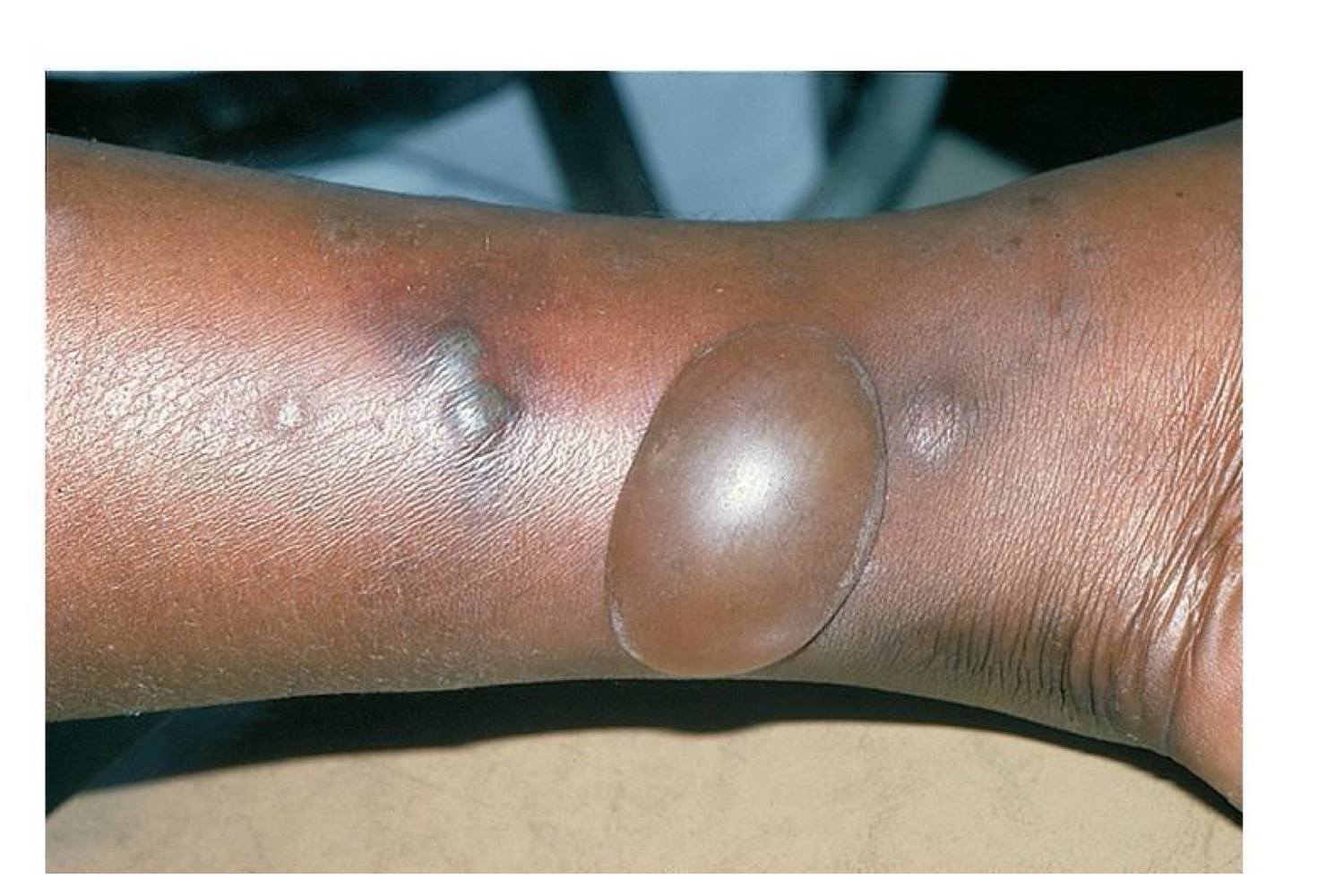 <p>what type of skin lesion is this? </p>