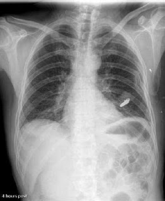 <p><span><span>•Chest:</span></span></p><p><span><span>–Lung (air), Ribs (bone), heart (muscle)</span></span></p><p><span><span>–High subject contrast: mostly black and white, with some grays in between</span></span></p>