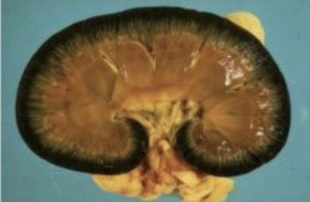 <p>most tissues will be yellow, but kidneys are black because of accumulation of RBC breakdown products</p>