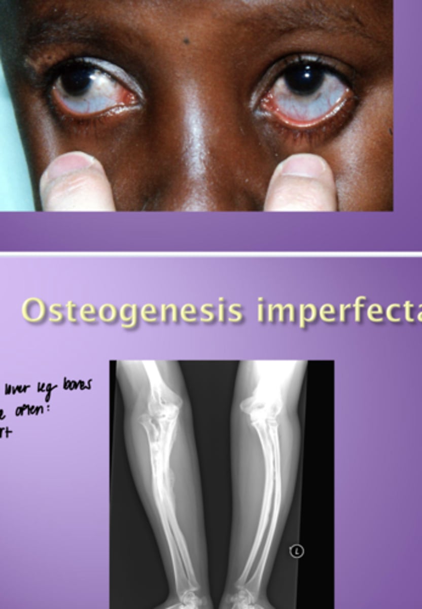 <p>- Blue sclera</p><p>- Bowed leg bones (pts often short)</p>