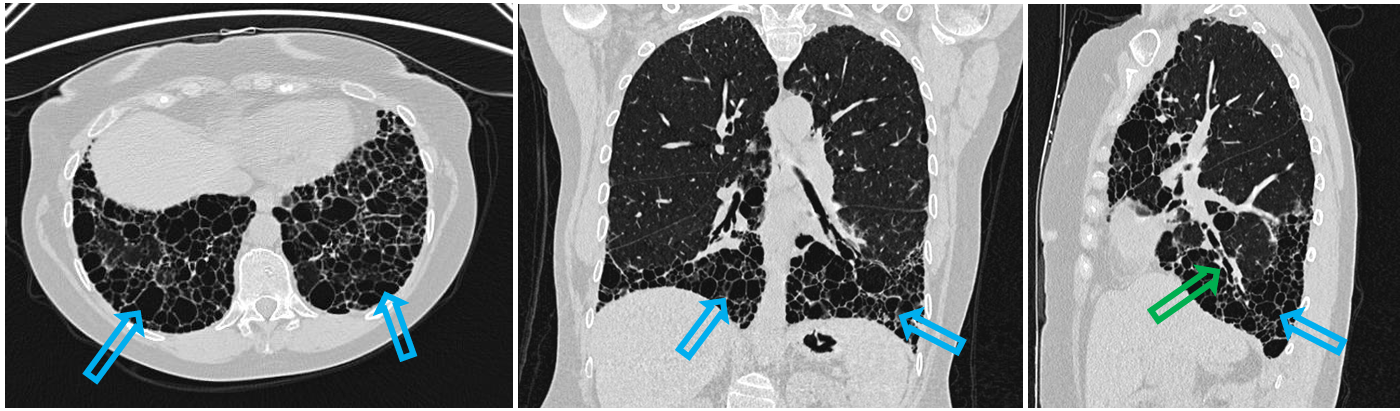 <p>Patient history: 56-year-old female patient with systemic lupus erythematosus with moderate restrictive ventilation problems </p><p>Modality: HRCT of the lung (non-contrast study), lung window </p><p>Region: chest, lung, axial-coronal-sagittal views</p><p>Radiologic sign: view bilateral dorsobasal predominant honeycombing and reticulation (blue arrows), traction bronchiectasis and thickened bronchial wall (green arrow) </p><p>Diagnosis: large-area interstitial lung disease, UIP (usual interstitial pneumonia) pattern</p>
