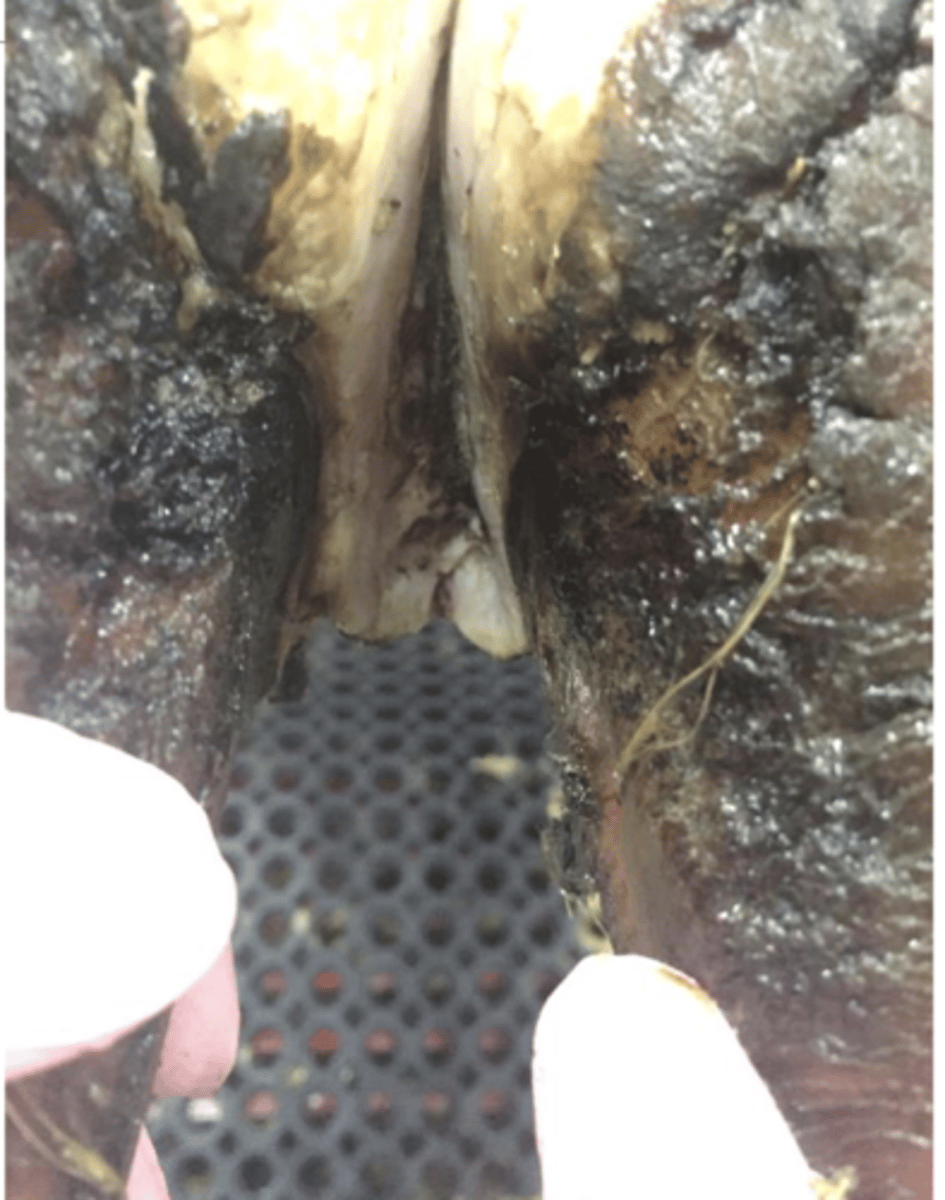 <p>A cow presents with maceration of the interdigital space. The animal is NOT lame. There is hyperkeratosis, exudate, and the animal is pressure sensitive. What do you think this is?</p>