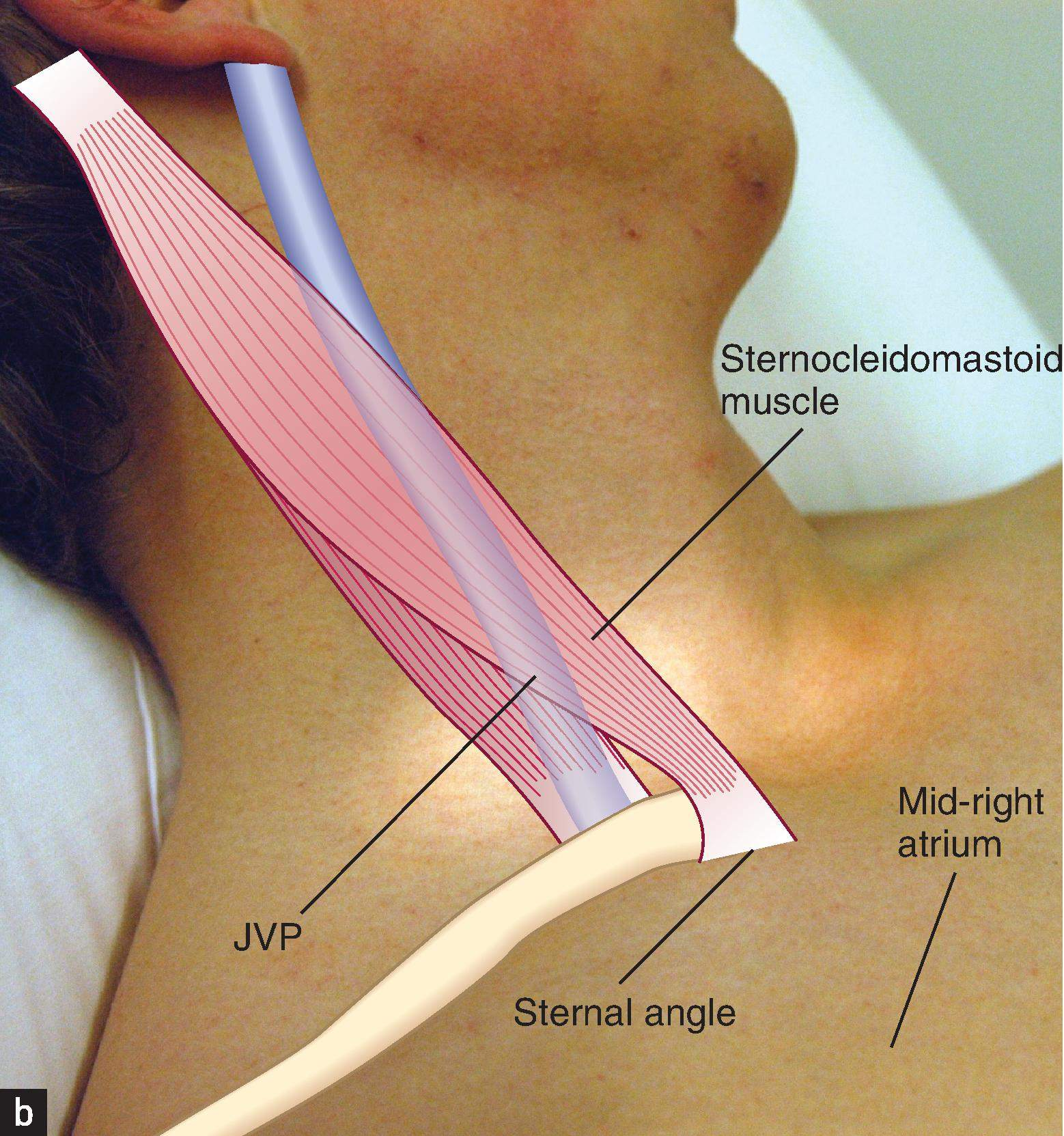 <ul><li><p>jugular venous pressure</p></li><li><p><strong>reflects right atrial pressure</strong></p></li><li><p>visible in around 50% of people</p></li><li><p>elevated JVP can indicate: </p><ul><li><p>right heart failure</p></li><li><p>fluid overload</p></li></ul></li><li><p>say: <em>“I’m looking at the base of the neck between the two heads of the sternocleidomastoid”"</em></p></li></ul><p></p>