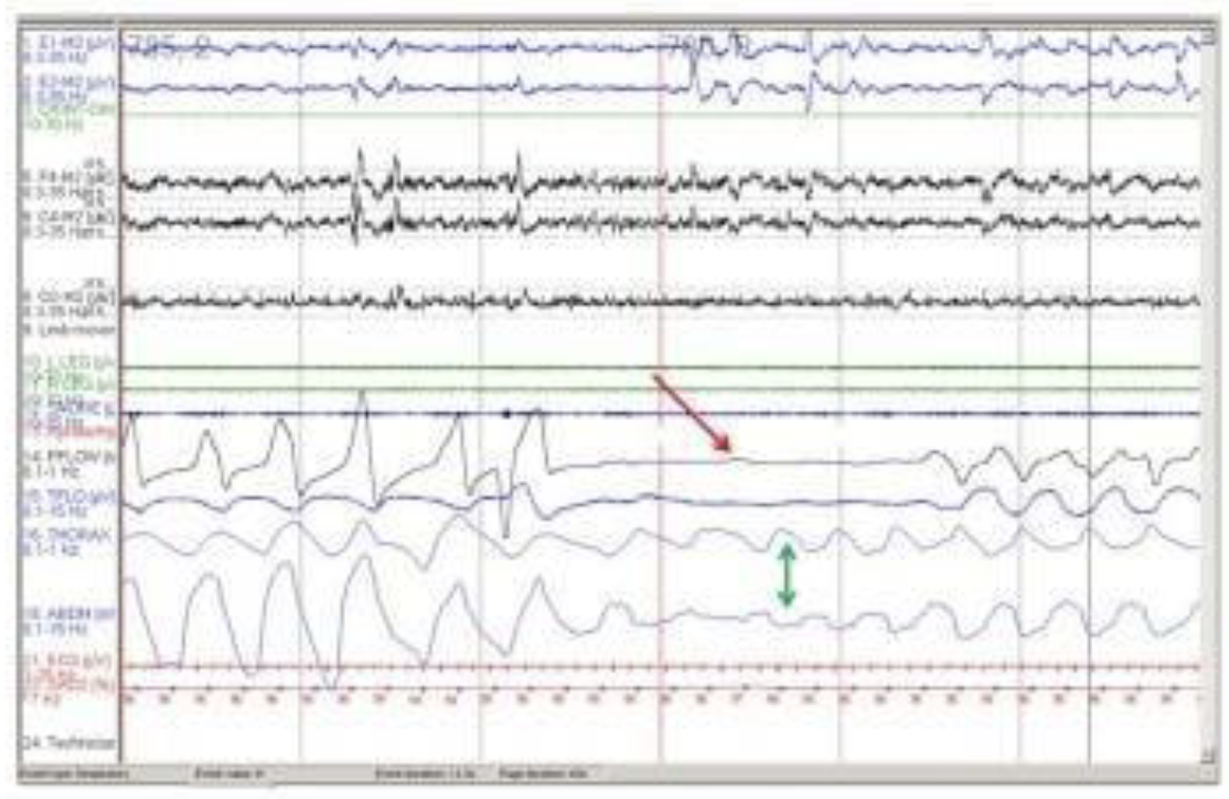 <p>A 50-year-old patient presents to their provider with complaints of excessive daytime sleepiness, fatigue and morning headache. Their partner reports loud snoring with witnesses pauses in breathing. Past medical history is significant for hypertension and a 30 pack-year history of smoking. On physical exam BP is 150/90 and BMI is 40. Polysomnography findings are as shown in the attached image. What is the most likely diagnosis?</p>