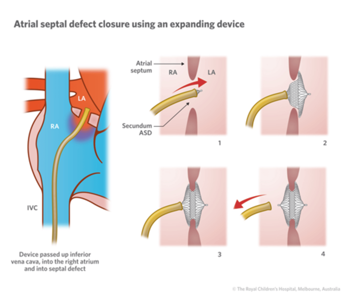 <p>hole will close on own, catheter closure if large</p>