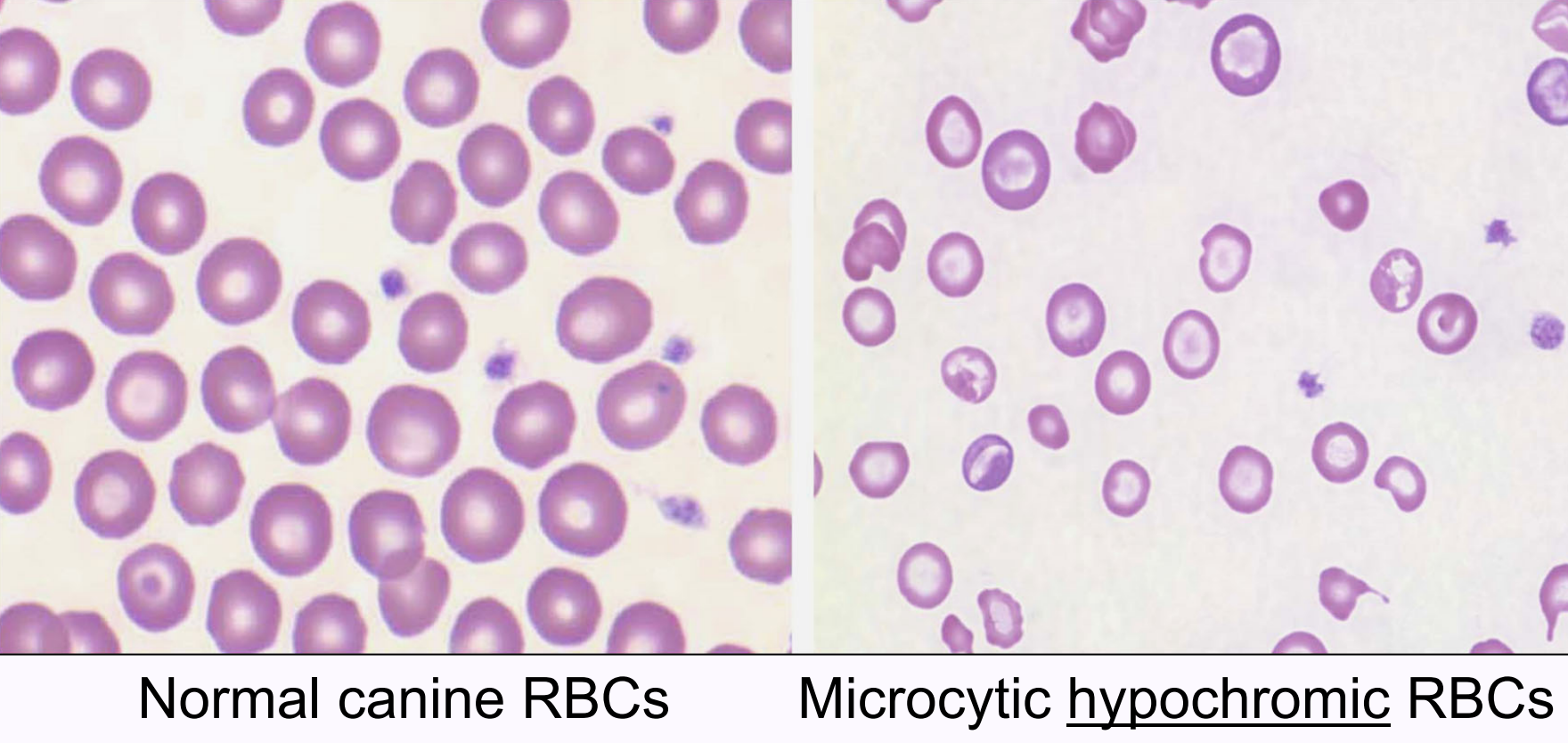 <ul><li><p><strong>microcytic</strong> RBCs that are <strong>pale with increased central pallor</strong> (>1/3 RBC diameter)</p></li><li><p>impaired hemoglobin synthesis due to <strong>iron deficiency</strong></p></li></ul><p></p>
