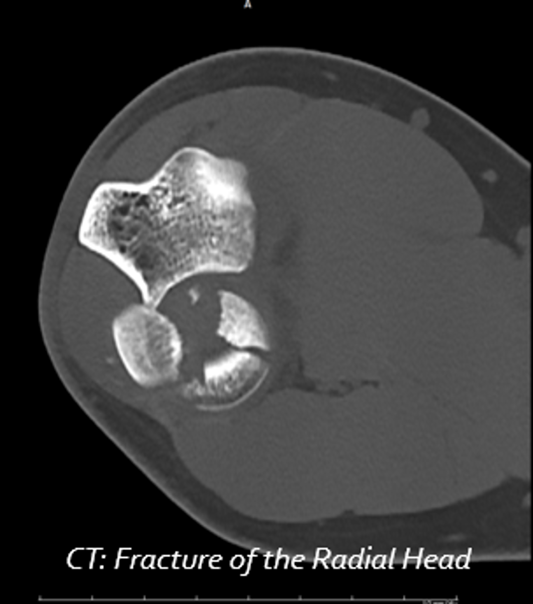 <p>1. Anatomical site and extent of fracture</p><p>2. Type of fracture</p><p>3. Alignment of fracture fragments</p><p>4. Direction of the fracture line</p><p>5. Special features of the fracture (avulsion, compression)</p><p>6. Associated abnormalities (Joint dislocation)</p><p>7. Fractures due to abnormal stress or pathological fracture</p>